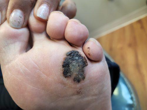 melanoma on big toe